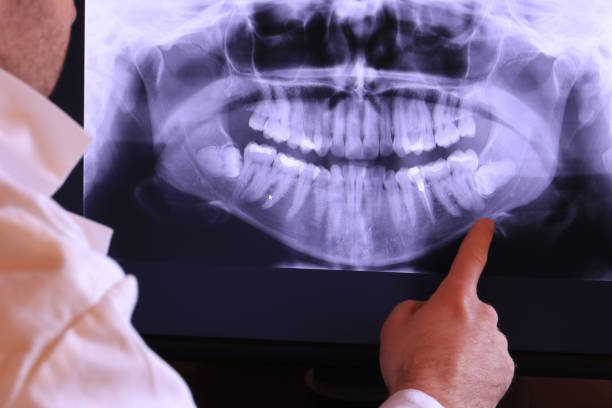 Best Emergency Dentist for Lost Fillings or Crowns in South Whittier, CA